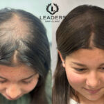 Hair Loss Combating